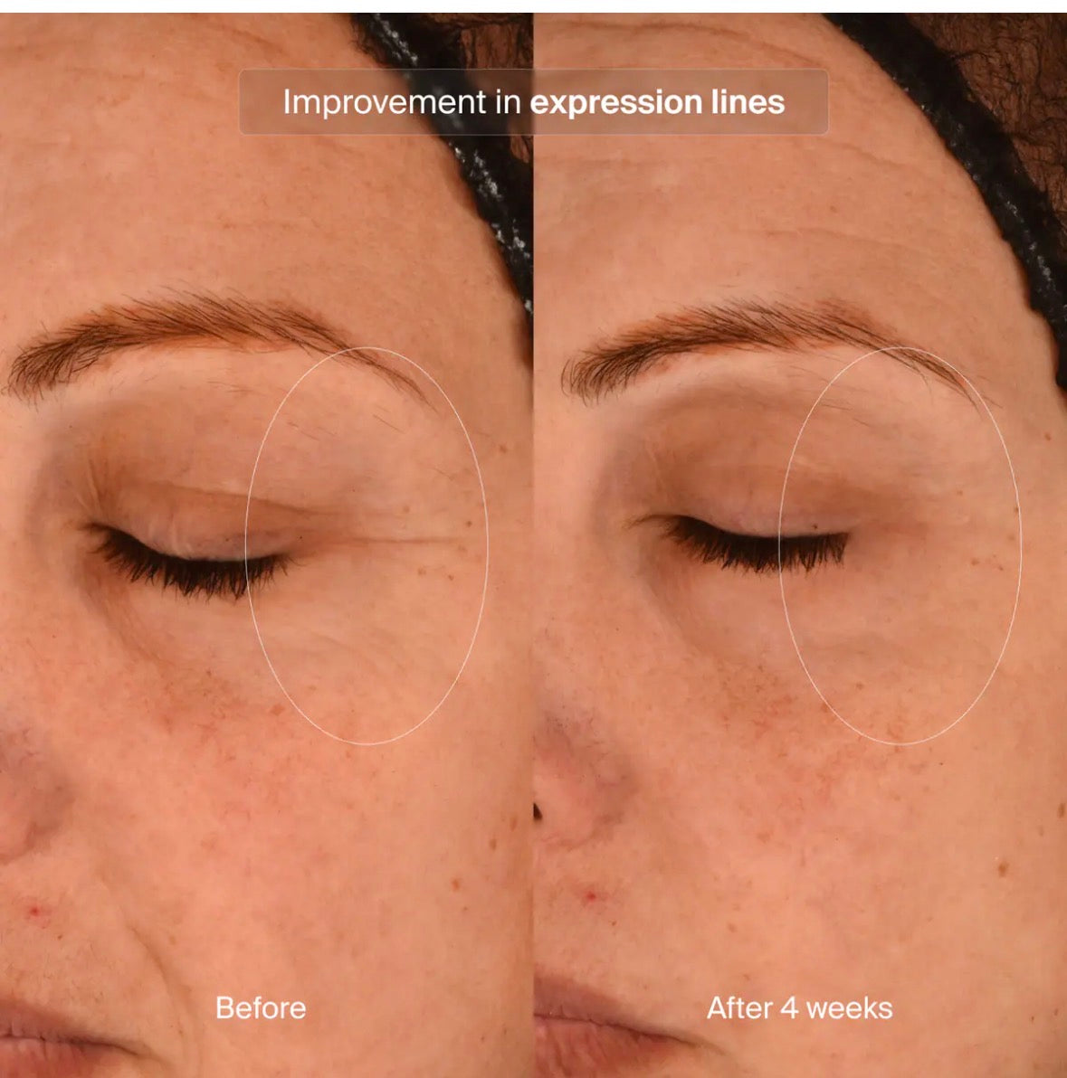 Precision Eye Lift